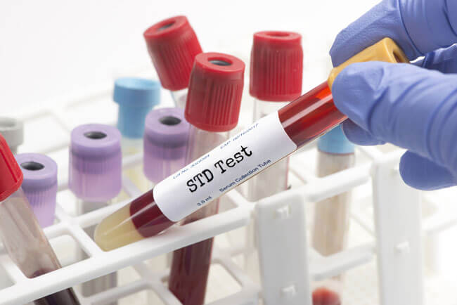 Any Lab Test Now STD Tests 