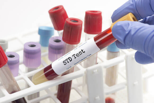 Any Lab Test Now STD Tests