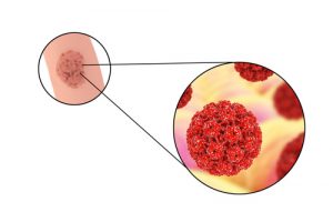 HPV Can Lead To Cancer