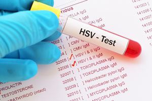 HSV test