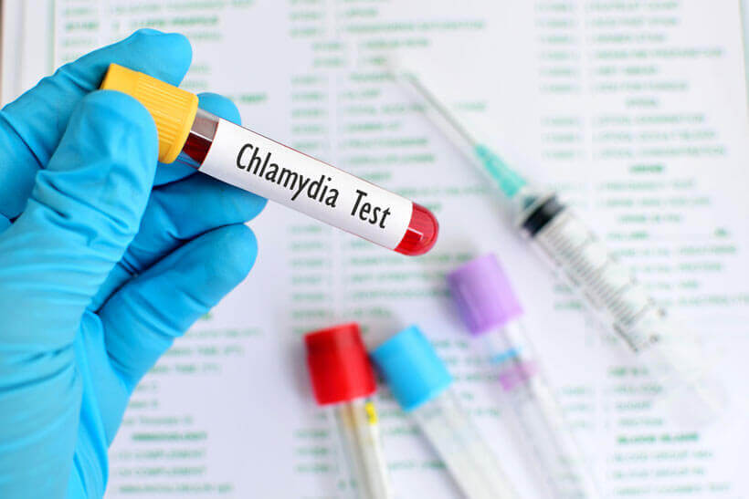 Getting Tested For Chlamydia – Avoiding the spread of Chlamydia