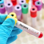 Best Herpes Tests Of 2018