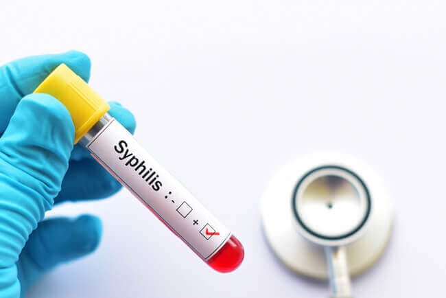 Everything You Need To Know About Syphilis Testing